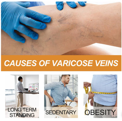 BEE VENOM VARICOSE VEINS RELIEF SPRAY (PACK OF 2) 🔥 BUY 1 GET 1 FREE 🔥