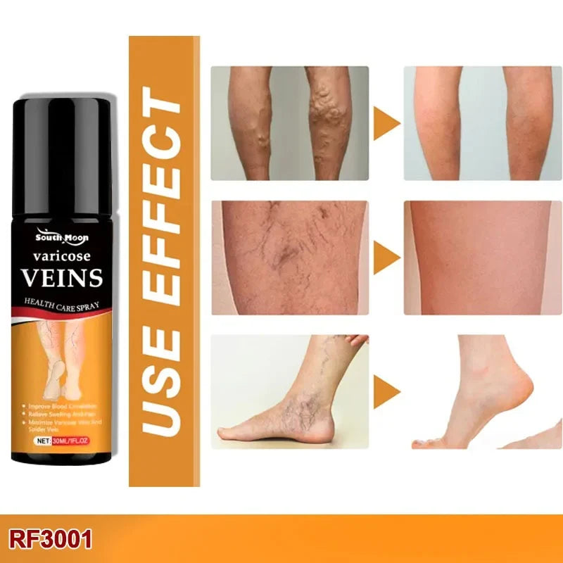 BEE VENOM VARICOSE VEINS RELIEF SPRAY (PACK OF 2) 🔥 BUY 1 GET 1 FREE 🔥